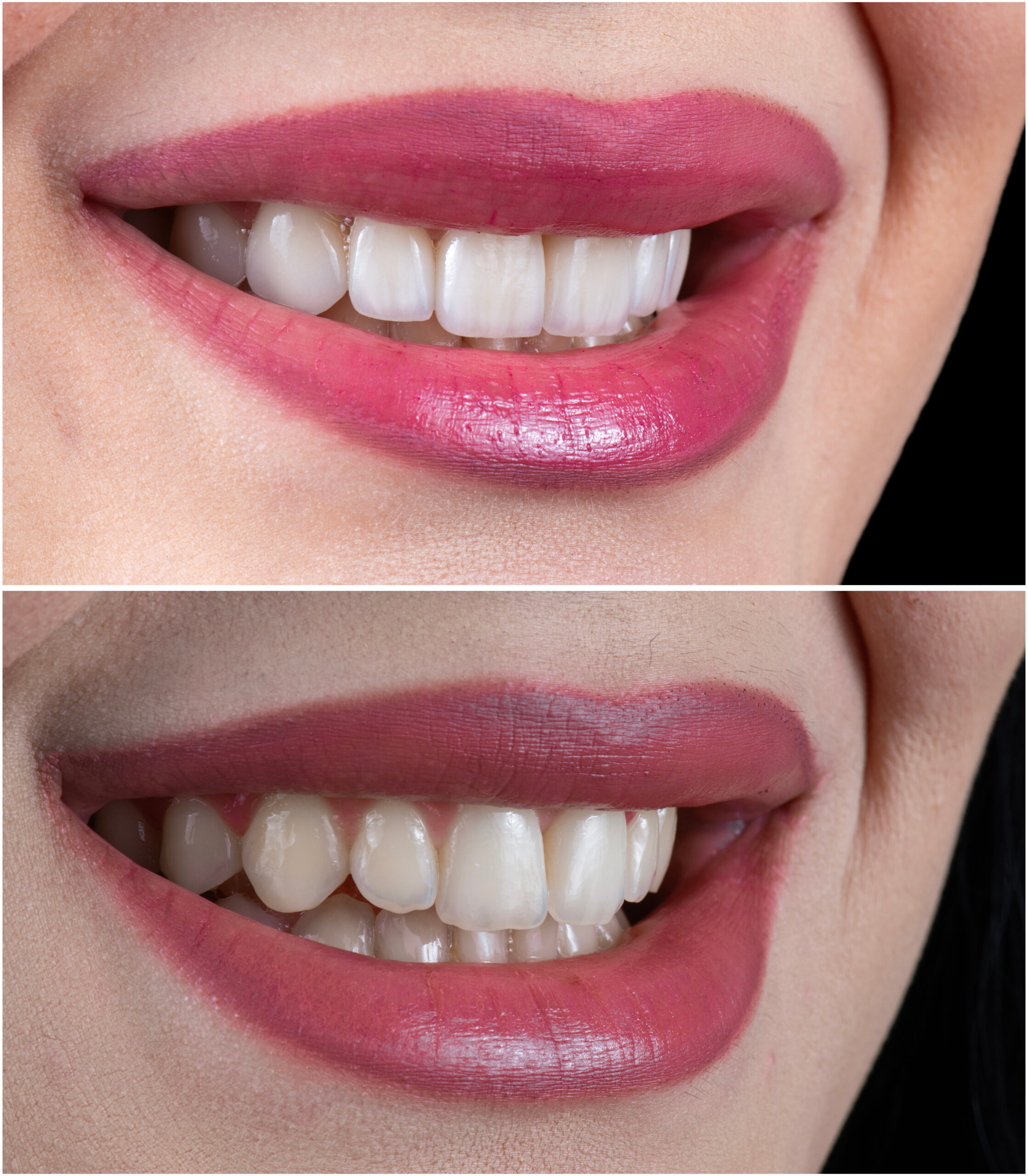 before and after picture of dental treatment by ceramic veneers