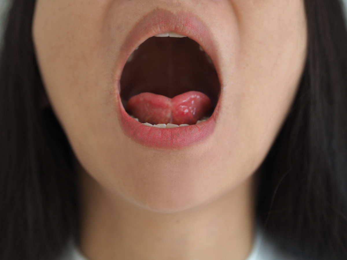 ankyloglossia in asian woman and cause of an unusually short of tissue tethers the bottom of the tongue to the floor of the mouth on isolated white background
