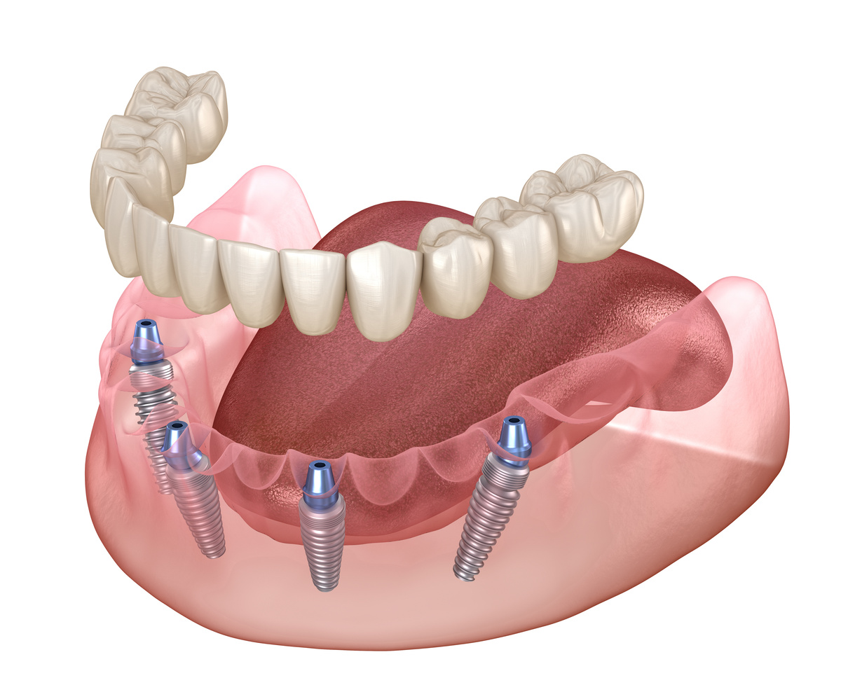 Mandibular prosthesis All on 4 system supported by implants. Med