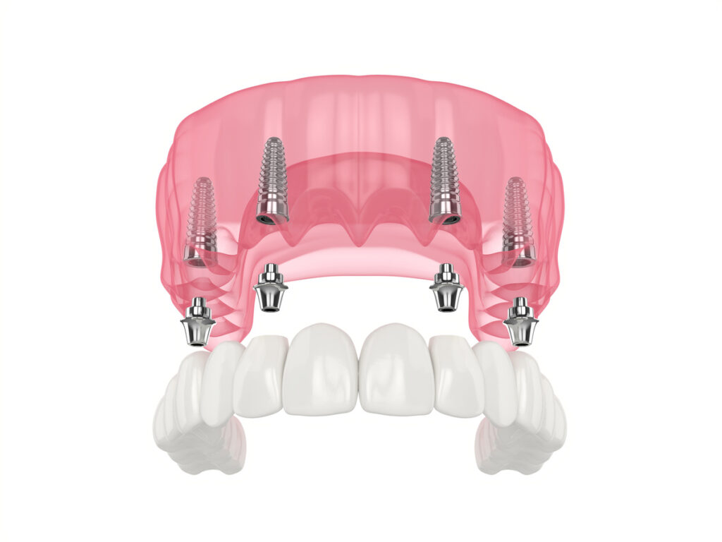 Mandibular prosthesis all on 4 system supported by implants